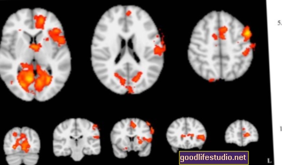 Neurofeedback Menunjukkan Janji Dalam Membantu Remaja Menguruskan Emosi