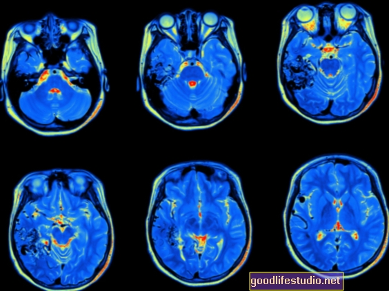 La neuroimagen mejora el éxito de la estimulación cerebral para la depresión