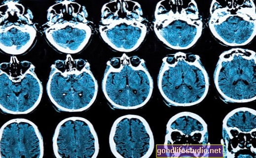 La neuroimagerie analyse des réseaux liés aux symptômes de la schizophrénie