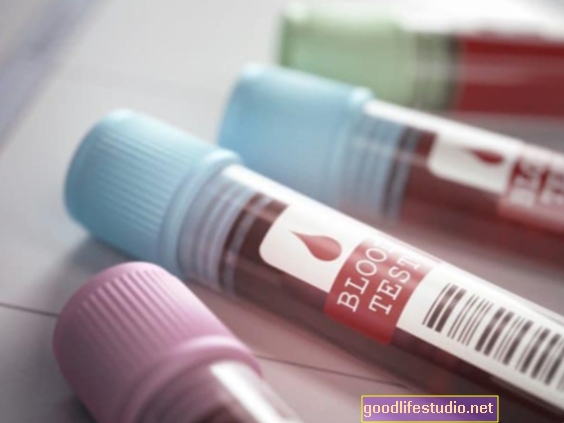 Neue Blutbiomarker können das Risiko einer Demenz vorhersagen