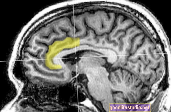 Új tanulmány nyomon követi az abnormális agyfejlődést a skizofréniában
