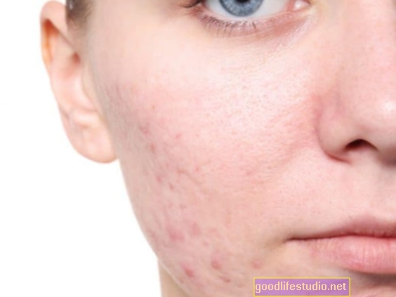 Lo stigma percepito dell'acne può influire sulla qualità della vita, specialmente nelle donne