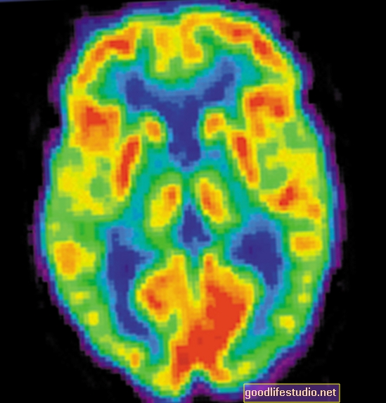 El agente de obtención de imágenes de PET puede identificar buenos candidatos para el fármaco de depresión