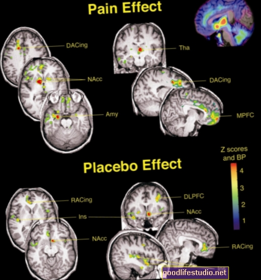 Placebo ārstēšana aktivizē smadzenes Parkinsona slimībā