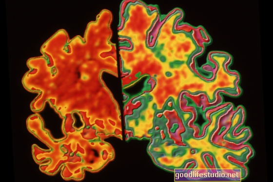 Плаките, открити в образа на мозъка, могат да предскажат болестта на Алцхаймер