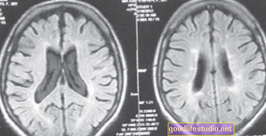 Az agy plakkjai lokalizálódhatnak az Alzheimer-kórban
