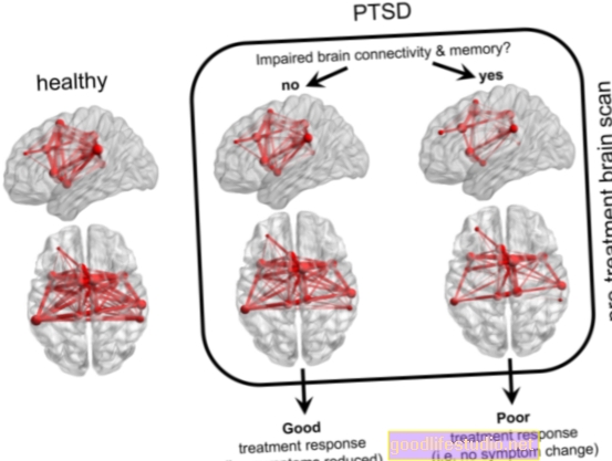I pazienti con disturbo da stress post-traumatico hanno una risposta cerebrale diversa alla paura