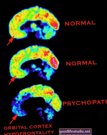 スキャンは精神病者が脳の異常を持っていることを示しています