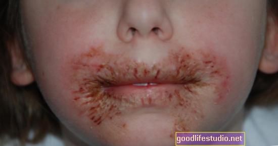 حساسية الأطفال مرتبطة بالوسواس القهري