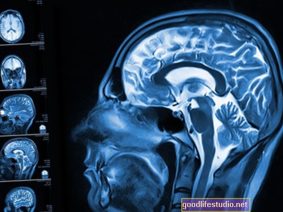 小規模な研究では、MRIを使用して認知症を予測しています