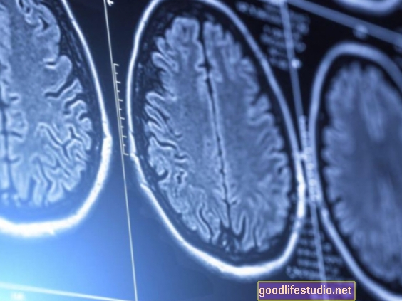 Някои мозъци от шизофрения показват ненормално натрупване на протеин, подобно на болестта на Алцхаймер