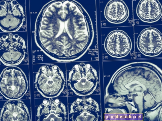 Spezifische Gehirnanomalie im Zusammenhang mit dem Risiko einer psychischen Erkrankung