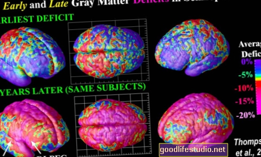 Anomalías estructurales del cerebro relacionadas con la esquizofrenia
