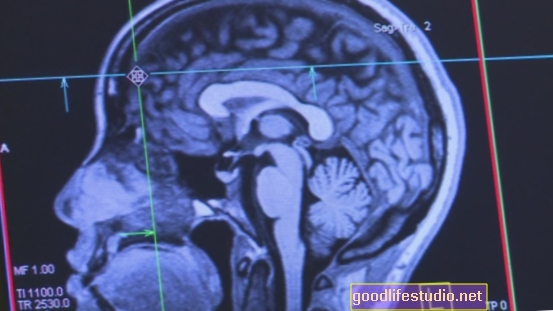 Preučite možganske mreže v anoreksiji