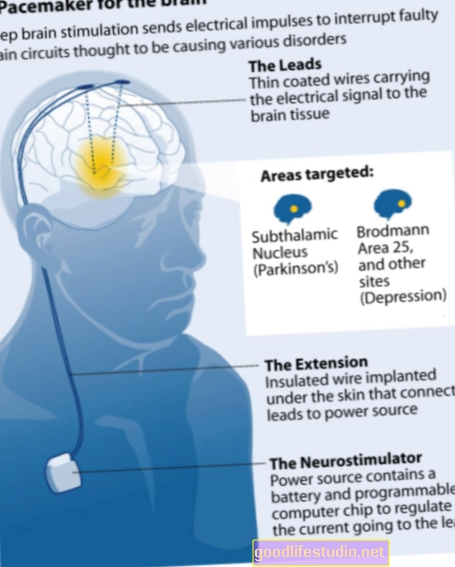 Mērķtiecīga smadzeņu stimulēšana palīdz satrauktiem cilvēkiem kontrolēt savas domas