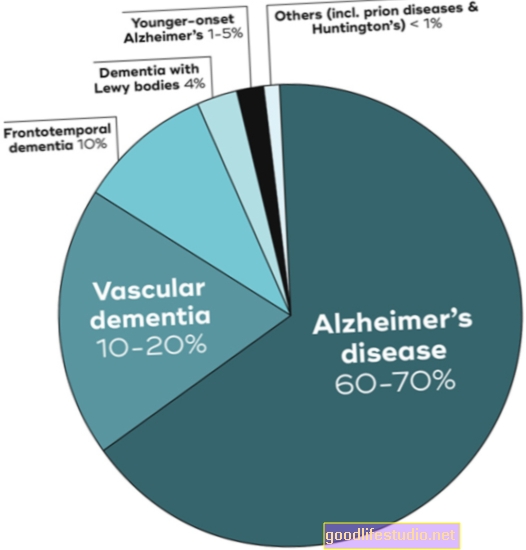 L'anomalia delle vene può avere un impatto sull'Alzheimer