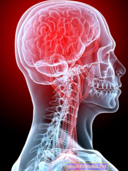 Najpogostejše vnetje v možganih bolnikov s fibromialgijo