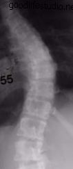 الجنف ، قبل الجراحة ، جراحة تنظير الصدر بمساعدة الفيديو (VATS)