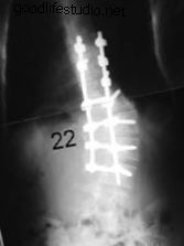 escoliosis, postoperatorio, resección de columna vertebral