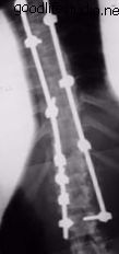 الجنف ، بعد العملية الجراحية ، النهج الخلفي