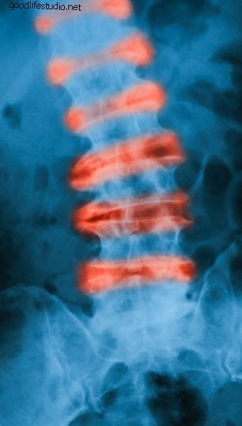 強直性脊椎炎における胸腰椎変形の外科的管理