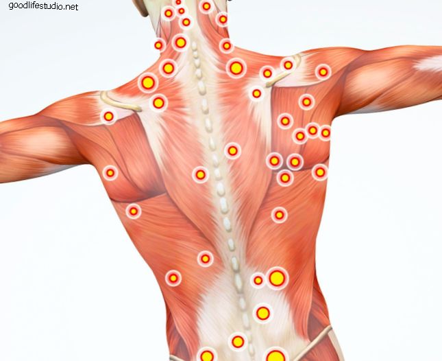 Muscles de la colonne vertébrale dans la douleur?  Le syndrome de la douleur myofasciale peut être à blâmer