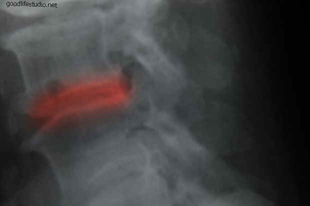 Příčiny selhání syndromu zády zad (FBSS)
