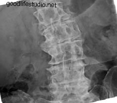 Хирургия на гръбначния стълб за сколиоза при възрастни
