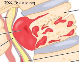 Tumori ale coloanei vertebrale: Tipuri benigne și maligne