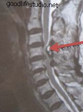 Zervikale Myelopathie und Rückenmarkkompression