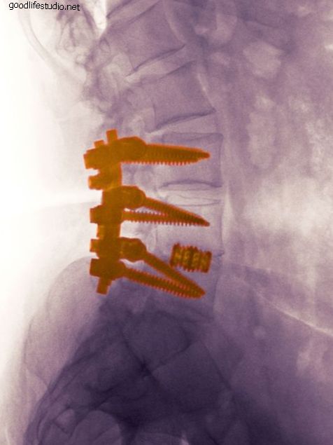 脊椎固定術、動的固定術、および椎間板置換