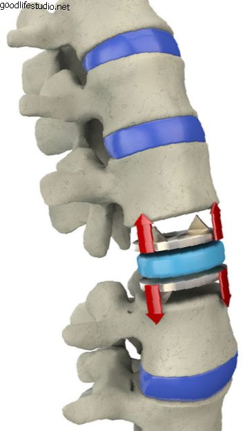人工椎間板を使用して治療された脊椎症性脊髄症
