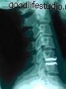 X-ray selepas pasca operasi, sambungan leher, cakera tiruan cervical Bryan®