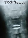 x-ray selepas operasi, depan ke belakang, cakera tiruan cervikal Bryan®
