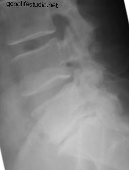 Рисунок 1: Боковой рентгеновский снимок - DDD на L5-S1