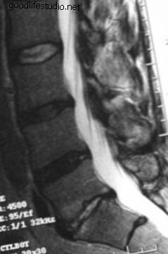 2. ábra: Oldalirányú MRI - DDD az L5-S1-nél