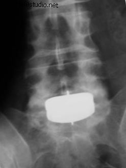 3. ábra: Elülső röntgen - PRODISC®