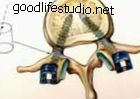 progrès de la technologie chirurgie mini-invasive de la colonne vertébrale vis pédiculaires sextantes tiges implantées