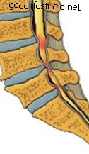 лумбална гръбначна стеноза