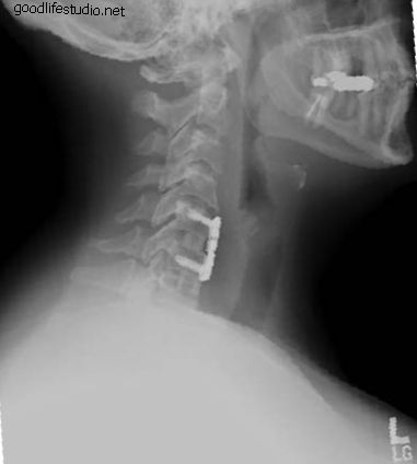Penggantian Cakera Buatan Cervical vs. Fusion Spinal