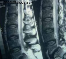 abra la fusión intercorporal lumbar anterior alif mri disco y placa vertebral cambios figura 610 caballero