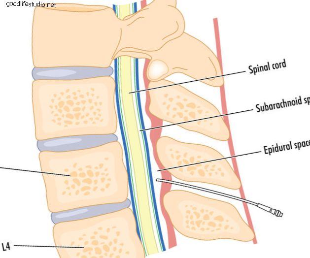 Che cos'è una prova di stimolazione del midollo spinale?