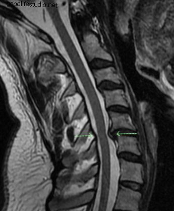 Zamenjava vratnega diska za bolečine v vratu ali rokah
