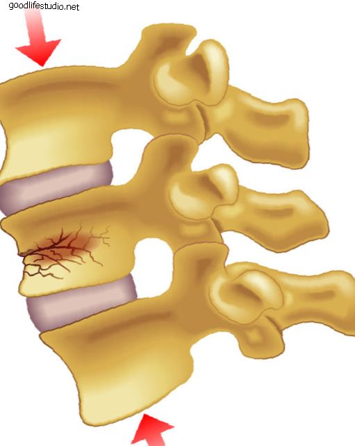 La vertebroplastia reduce el dolor después de las fracturas de columna