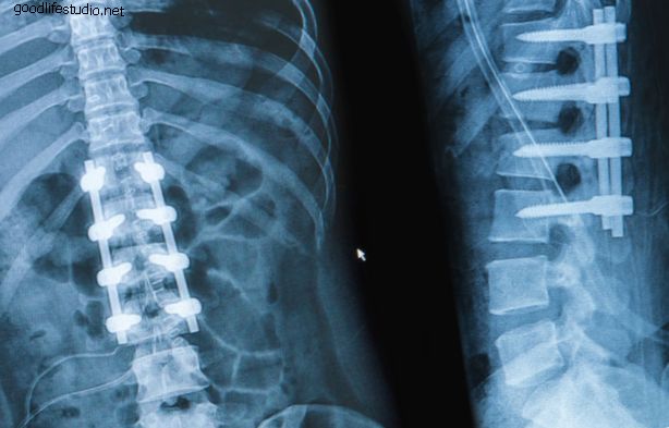 Tipos de injerto óseo para cirugía de fusión espinal